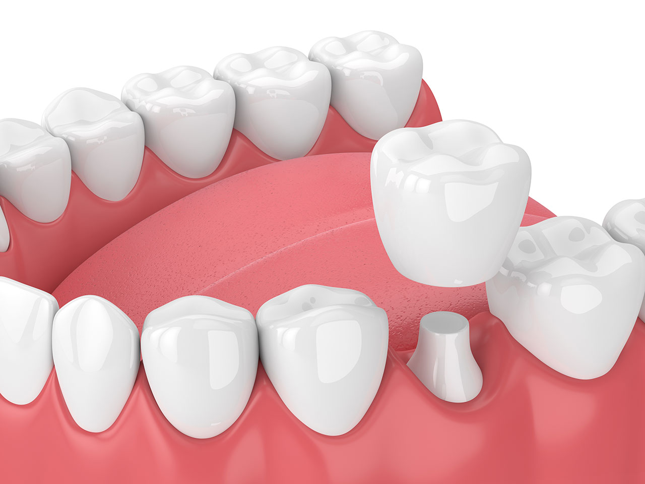 Do I Need a Dental Crown for a Cracked Tooth? Signs, Treatment, and Timing in Santa Ana