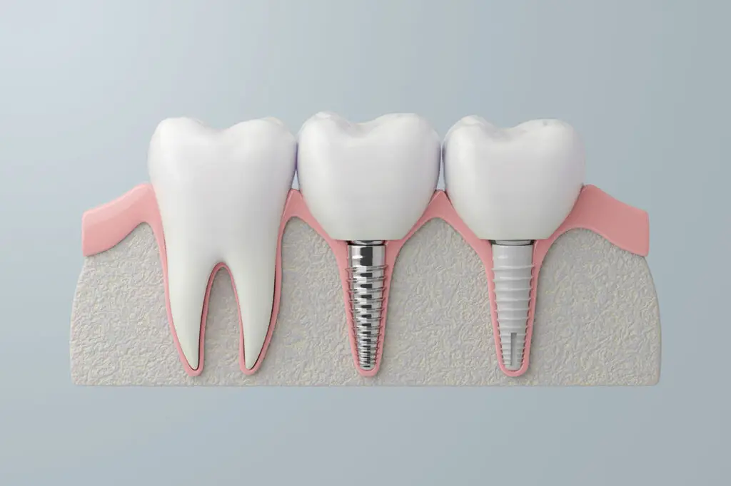 How Long Do Dental Implants Last? A Santa Ana Guide to Care, Maintenance, and Warning Signs