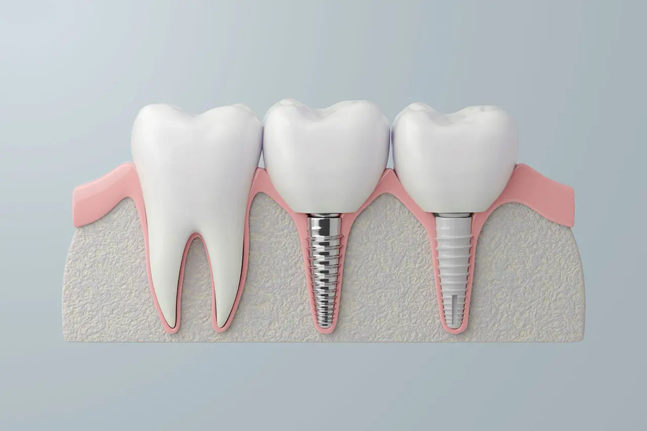 How Long Do Dental Implants Last? A Santa Ana Guide to Care, Maintenance, and Warning Signs