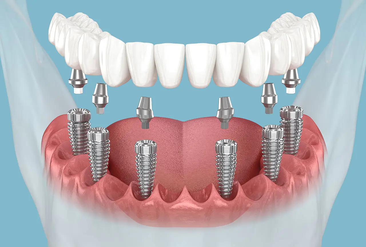 All-on-X Dental Implants in Santa Ana, CA