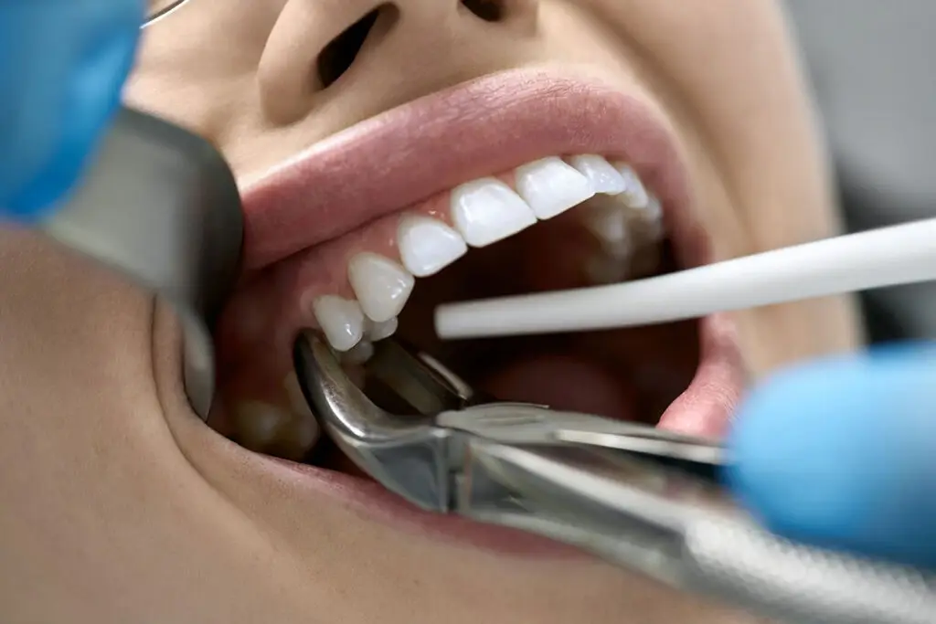How Soon Can You Get a Dental Implant After Tooth Extraction? A Santa Ana Timeline Guide