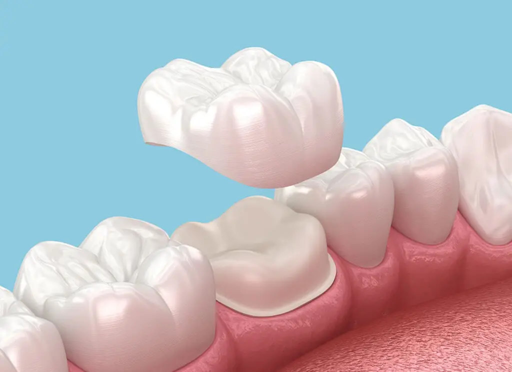 Dental Crowns: Zirconia vs. Lithium Disilicate, The Materials, Longevity, and Costs